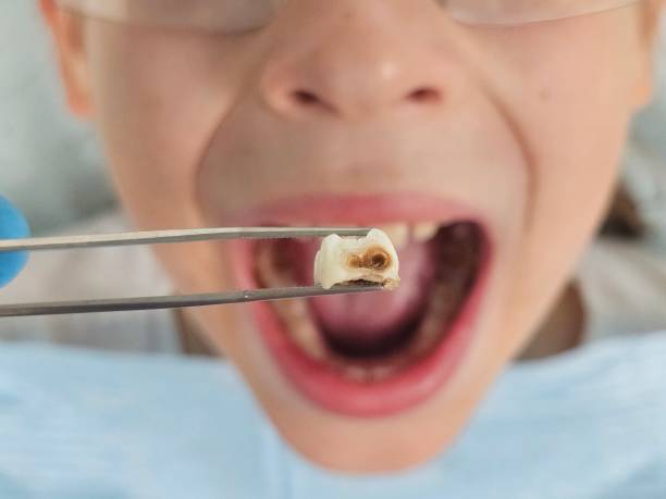 Best Emergency Treatment for Dental Infections or Abscesses in Dequincy, LA